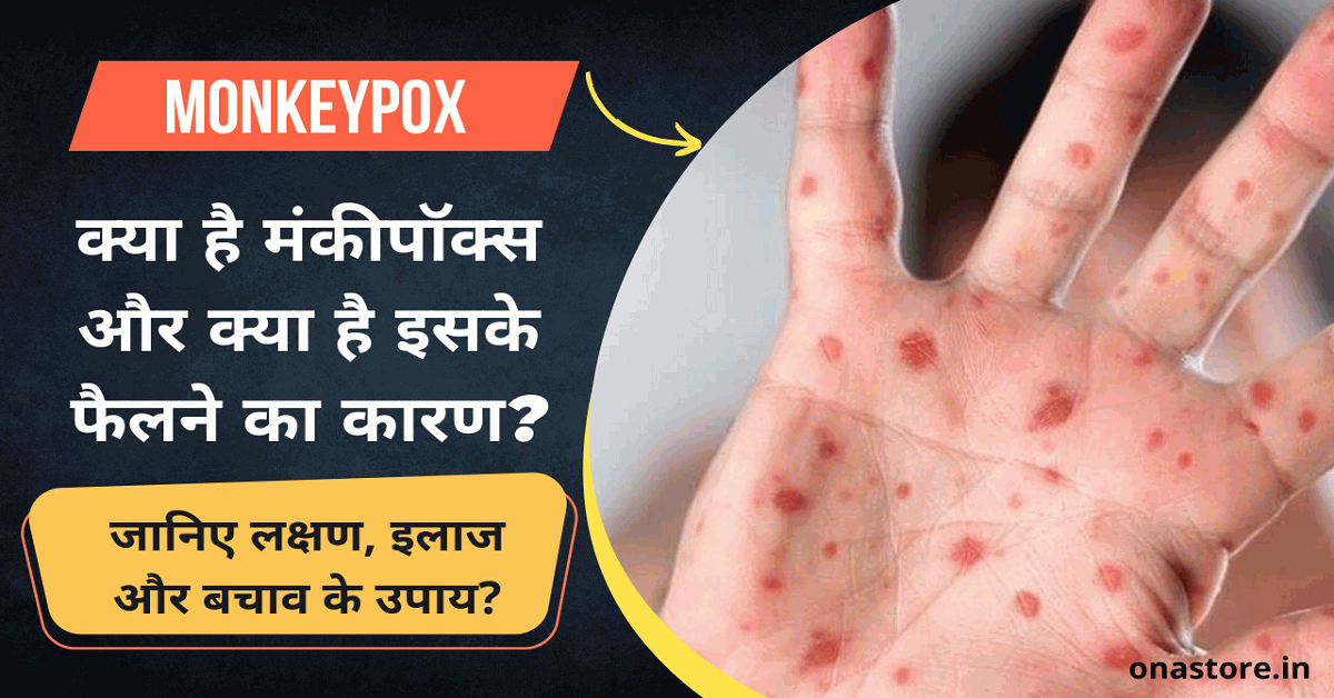 Monkeypox: क्या है मंकीपॉक्स और क्या है इसके फैलने का कारण? जानिए लक्षण, इलाज और बचाव के उपाय?